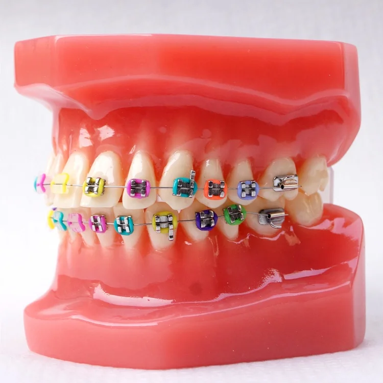 Dental Orthodontic model With metal bracket