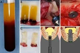 A-PRF and L-PRF tube for dental