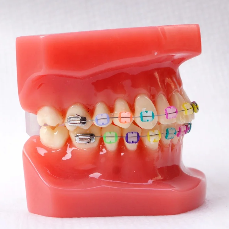 Dental Orthodontic model With metal bracket