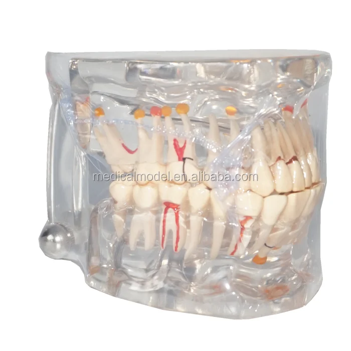Dental Implant Disease Teeth Models