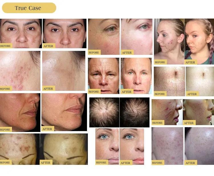 Beautforever Derma Rolling System Micro Needling 192 Needles zgts Derma Roller