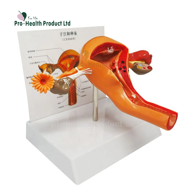 Female Pathological 3D Plastic Uterus Ovary Anatomical Model