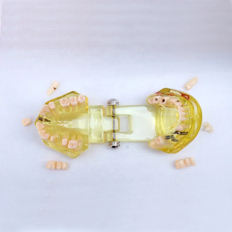 Tooth Restoration model with Implant