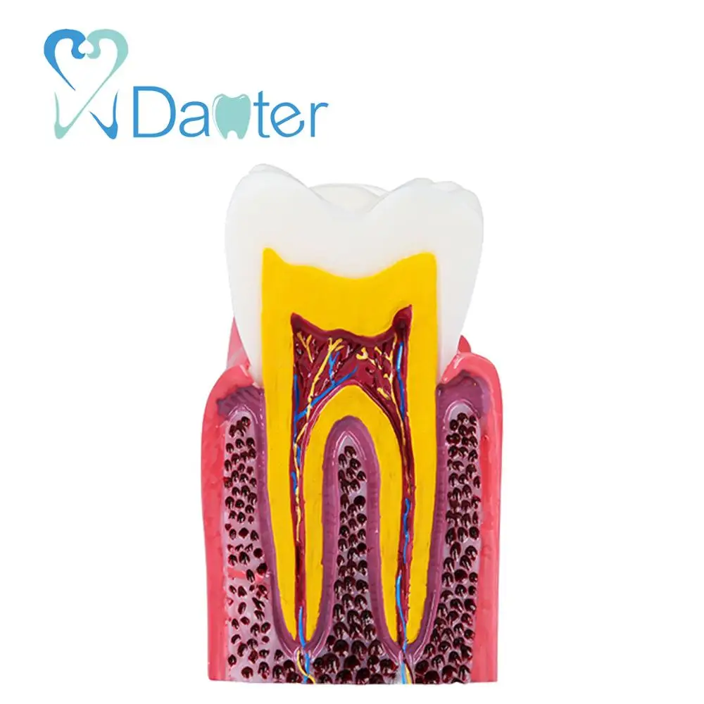 High Quality Caries Model Tooth Model for Dentist Patient Communication