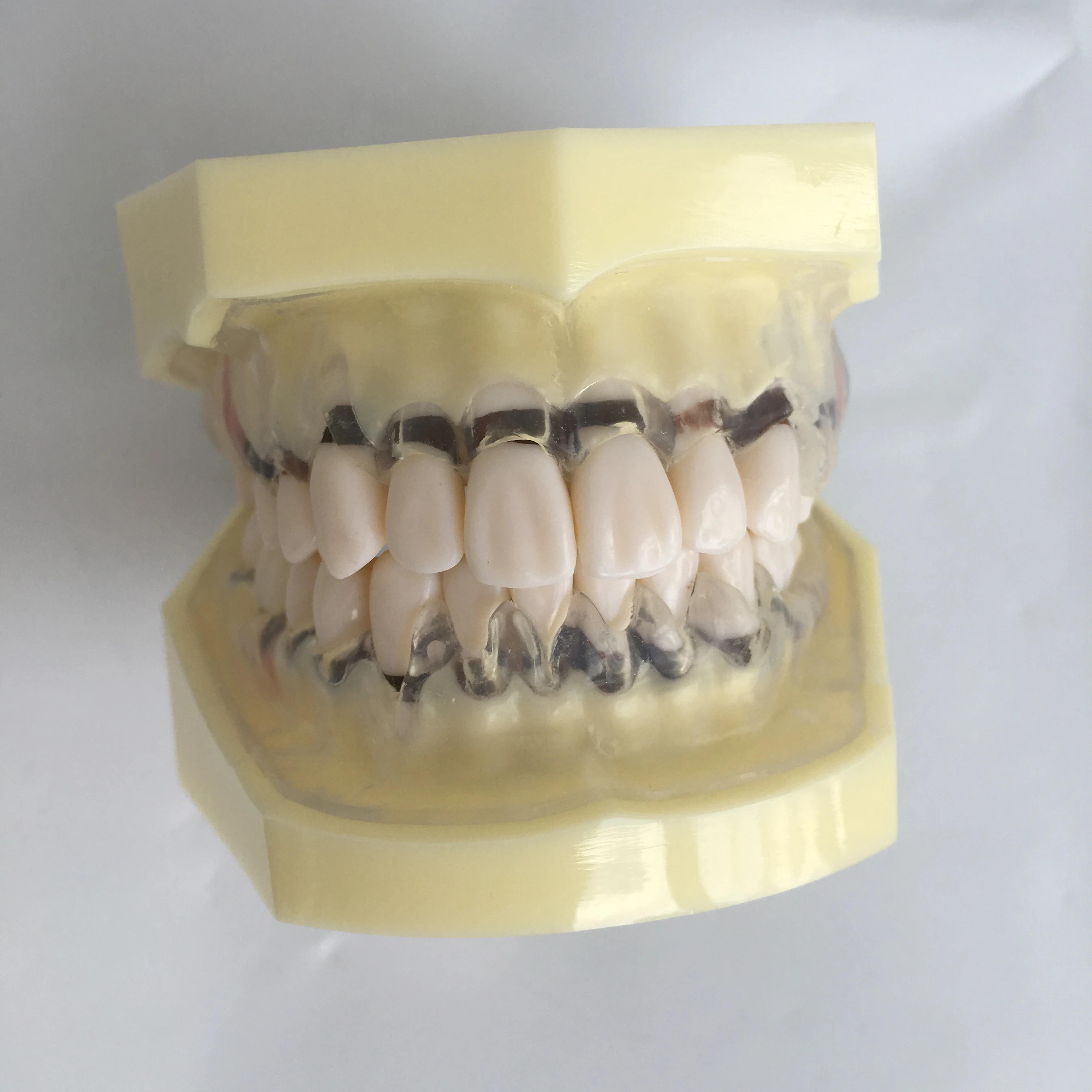 Peroidontal disease dental model with transparent clear gum demostrates ginivae recession