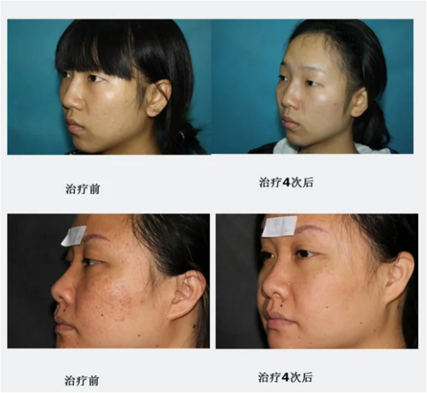 1470nm Endolifting laser, non-fractional skin resurfacing laser