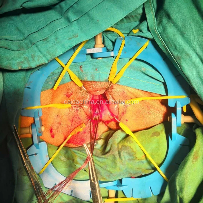 Single use Gynaecology retractor ring,disposable retractor ring R01.with 8 same hooks