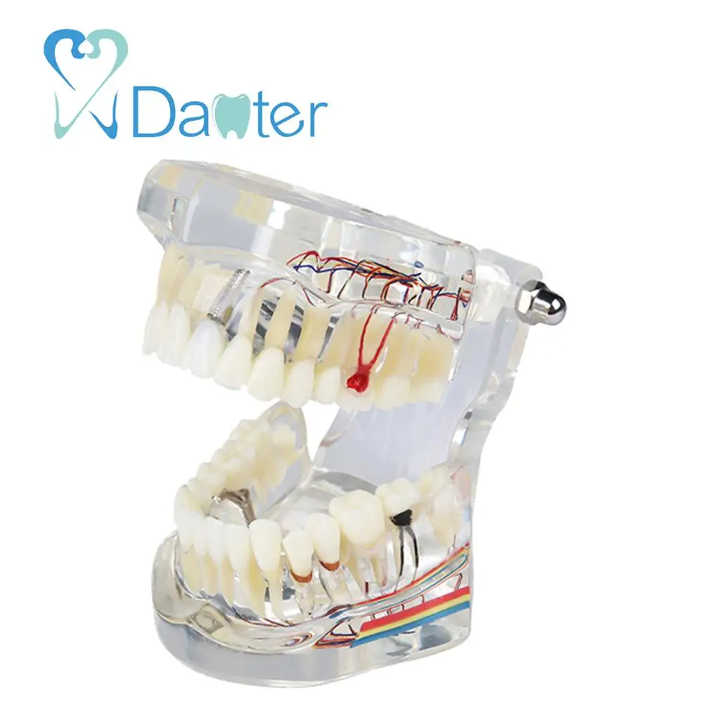 A200-2 All in one Dental Implant Model with Nerve and Removable Teeth crown bridges