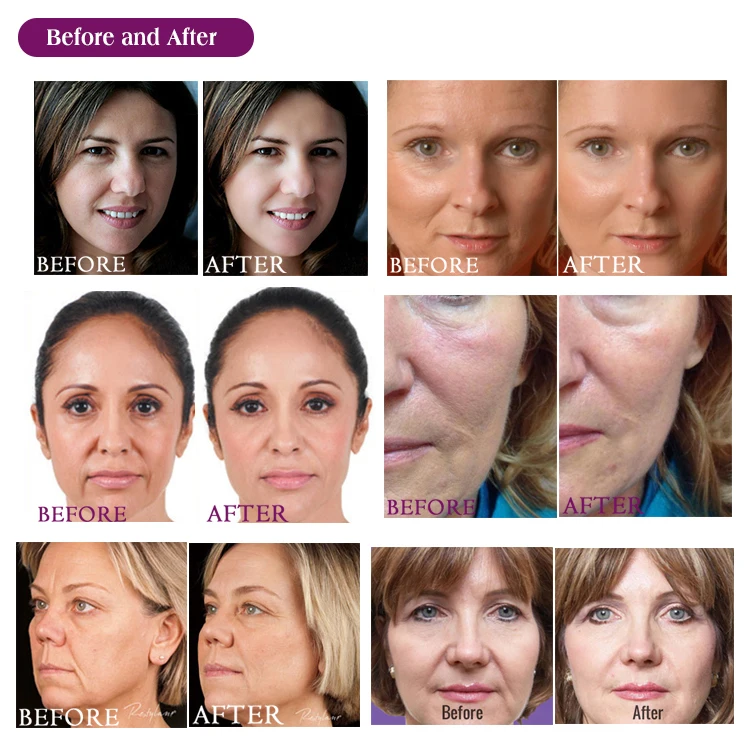 Beautforever mesotherapy cocktail solution skin rejuvenating wrinkle removal hyaluronic acid serum