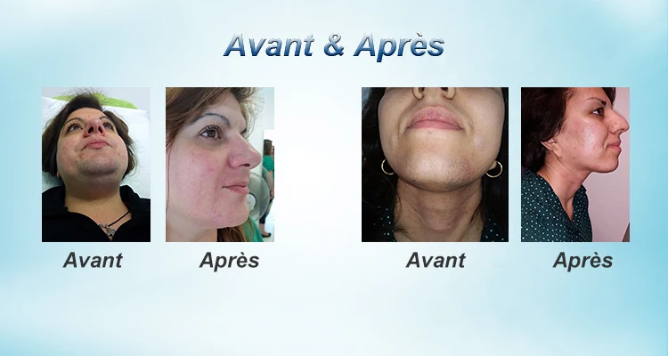 Professional Laser Hair Removal Machine Clear Brilliant Laser Depilation 808nm Diode Laser