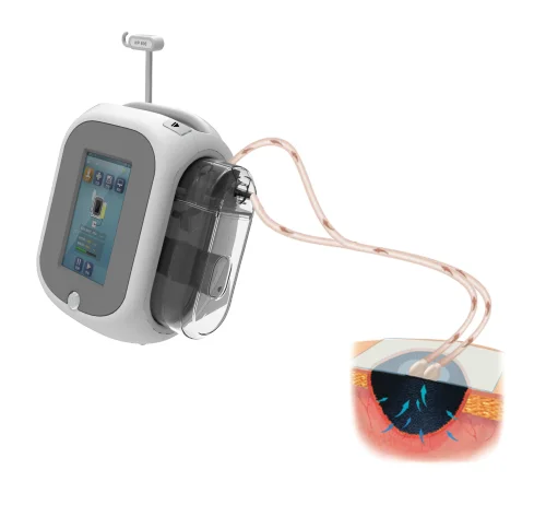 
NPWT instillation with 500 ml /1000 ml capacity canister 