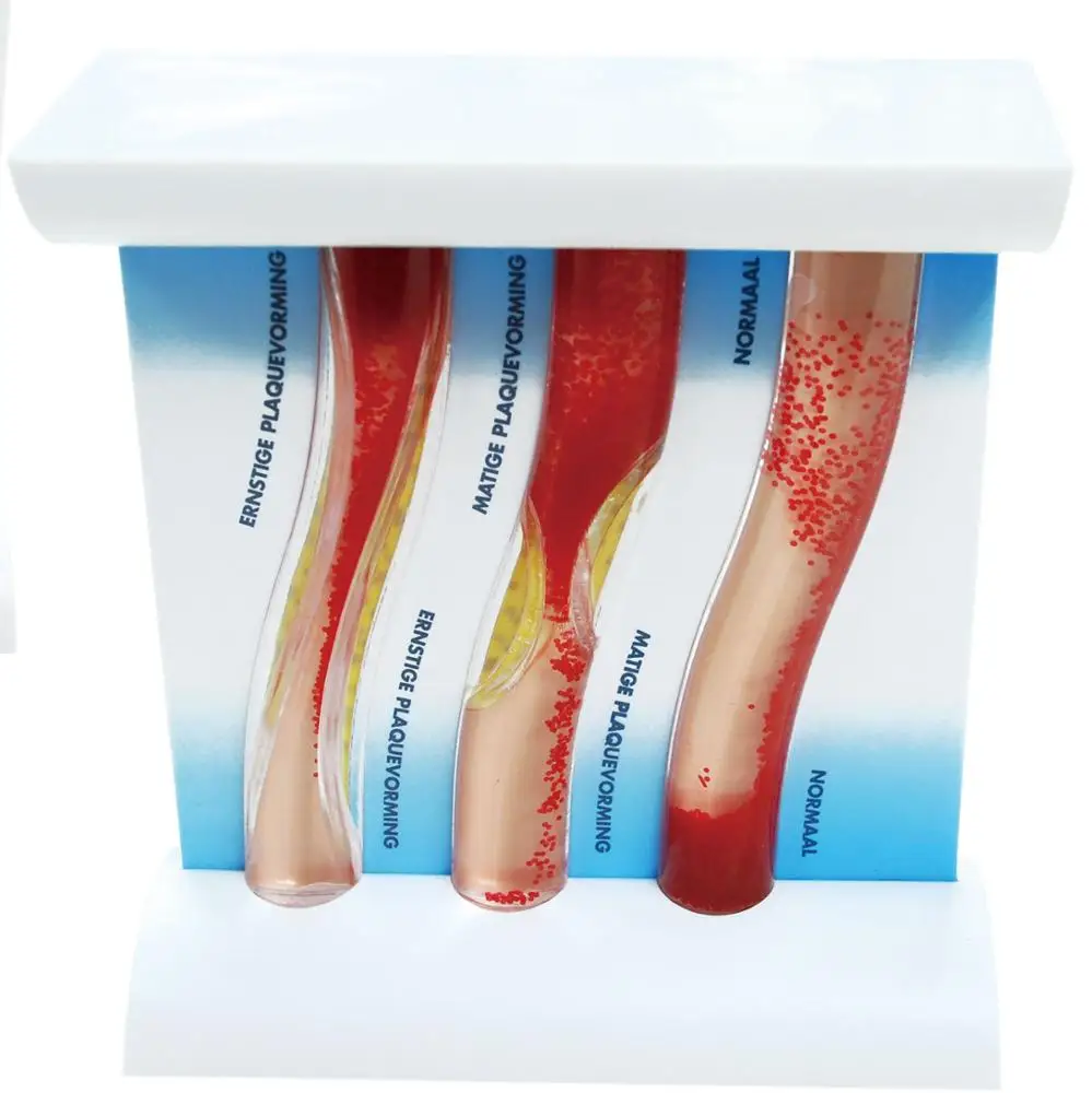 Dynamic Hyperlipidemia Blood Vessel Simulation Model