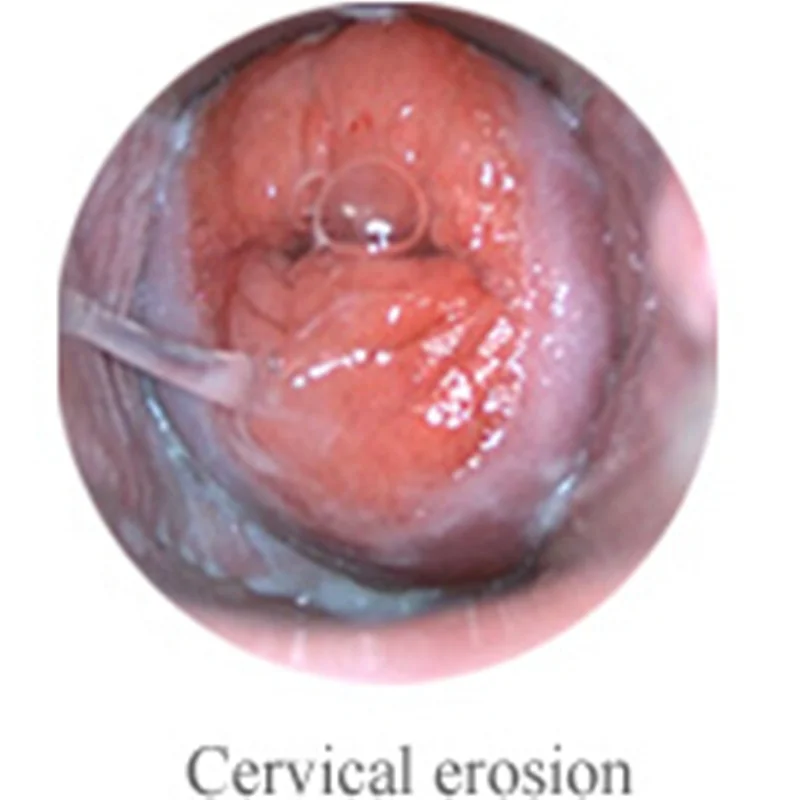 
Electronic Handheld Video Colposcope Price Colposcopy For Uterine Examination 