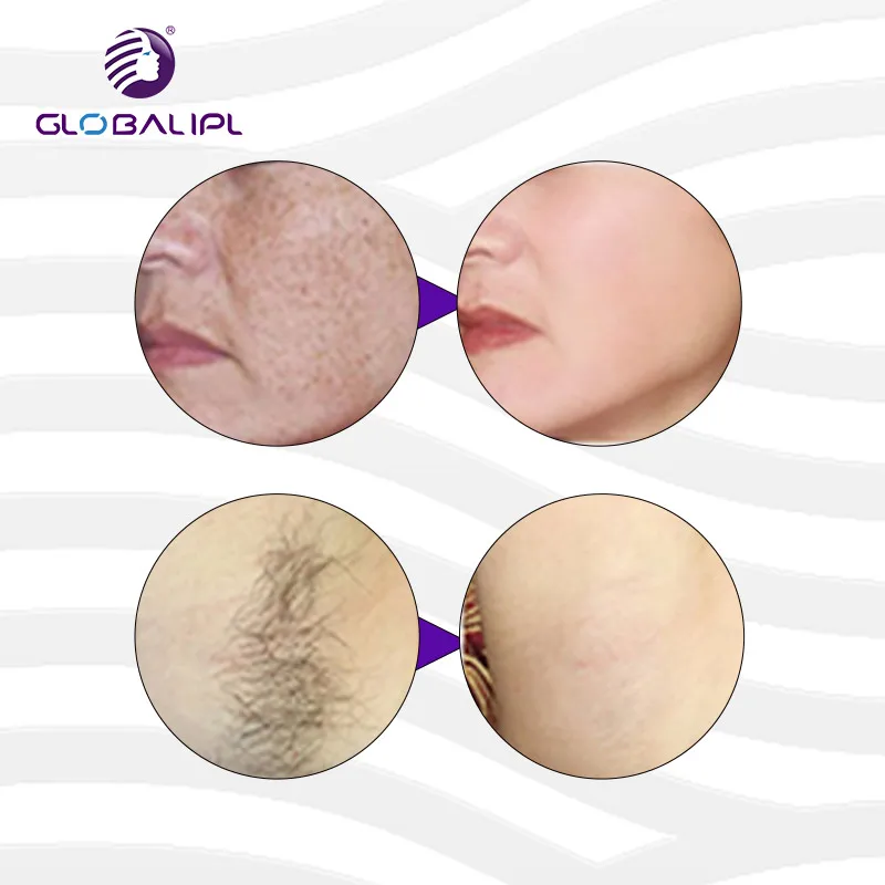 Skin Rejuvenation / Pigment Therapy/ Wrinkle Removal Multi-Functional IPL Skin Care Device