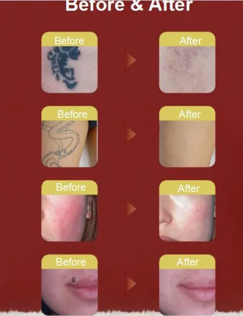 
Factory sale 1064nm 532nm Pico second q switched nd yag laser pico pigmentation removal laser machine 