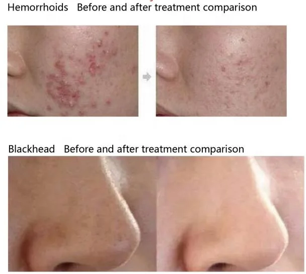 7 in 1 photon light therapy aqua peel solution diamond microdermabrasion machine