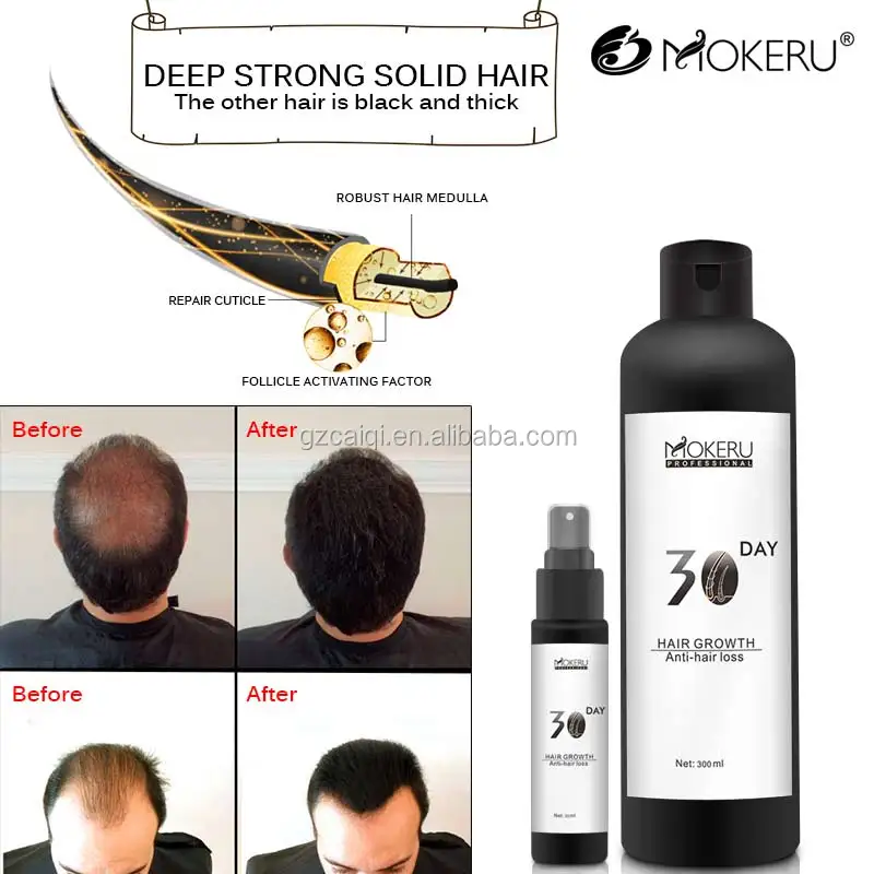 Mokeru Hair Growth Medicine And Naturel Hair Growth lotion For Baldness person