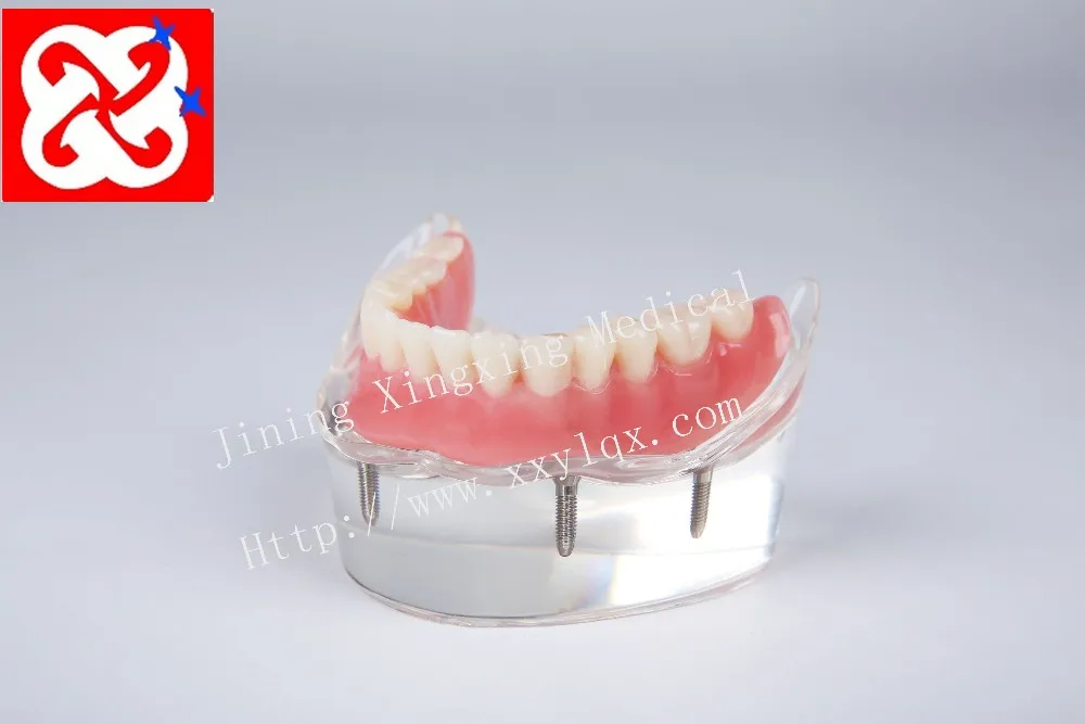 Mandibular overdenture имплантат зубов с 4