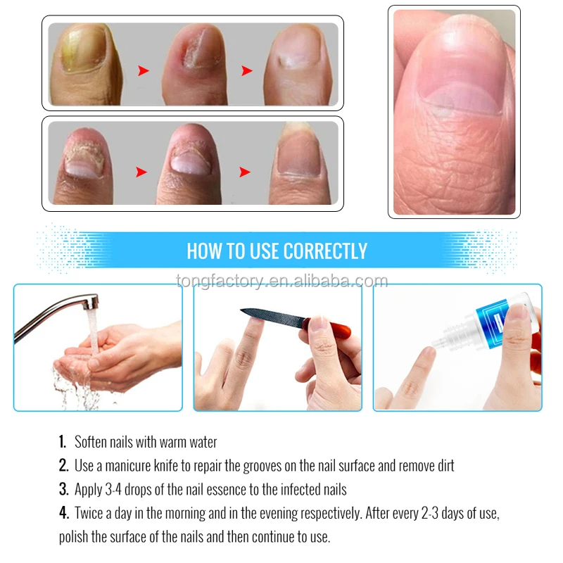 OMYLADY Nail Fungus Treatment Herb Nail Repair Cream