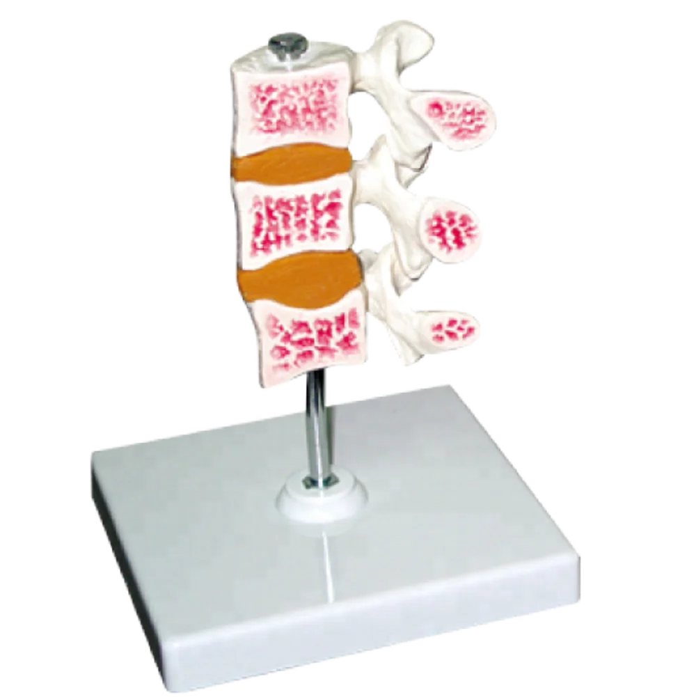 Advanced Osteoporosis Model, 3 Bones