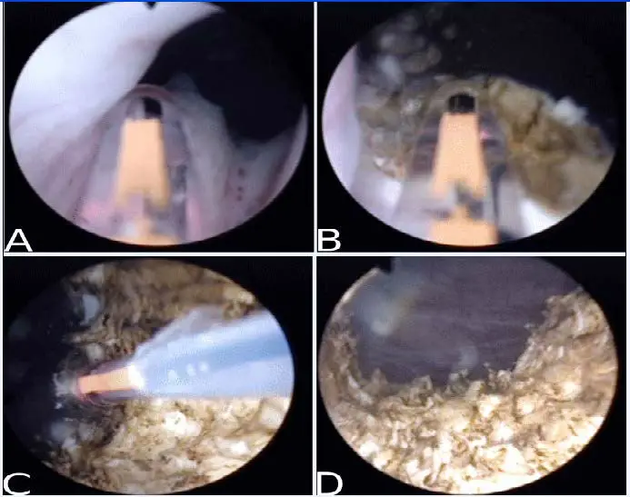 150W Prostate surgery diode laser