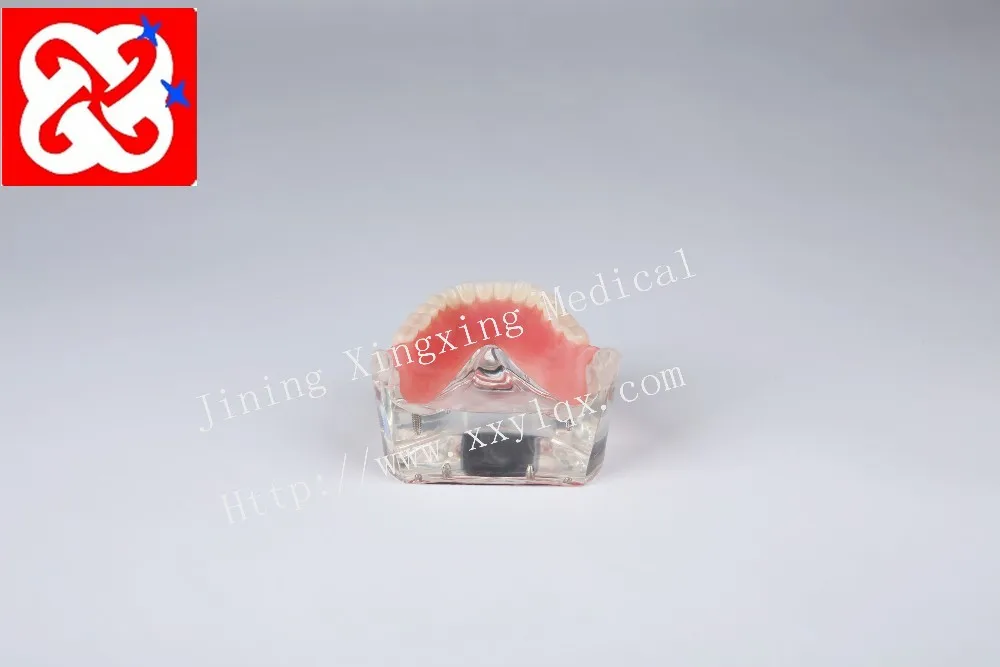 Mandibular overdenture имплантат зубов с 4