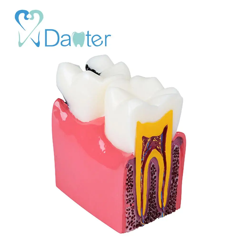 High Quality Caries Model Tooth Model for Dentist Patient Communication
