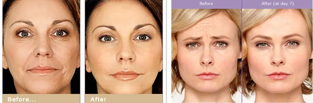 Cryo Cool Hot Electroporation No Needle Mesotherapy Skin Face Lifting Machine