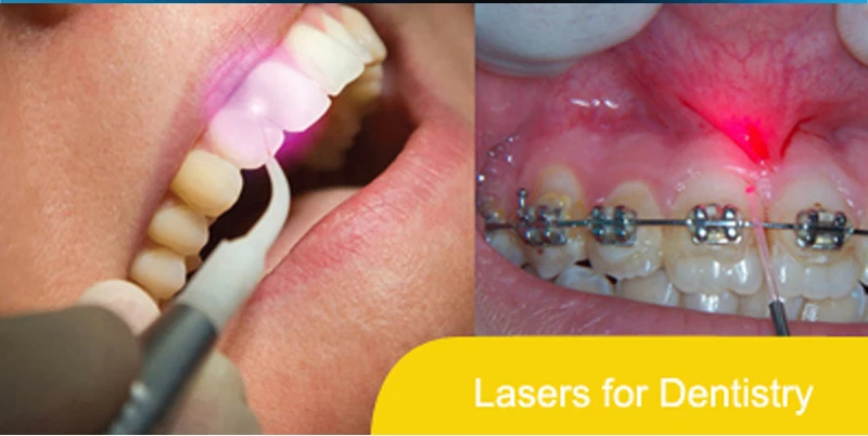 
2018 Hottest product 980nm diode laser machine for vascular spider veins removal and PLDD laser surgery laser 