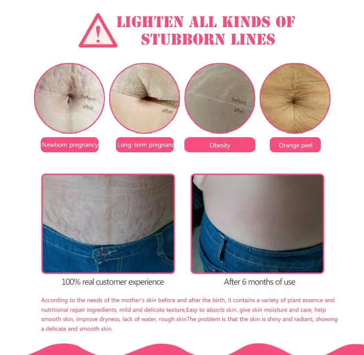 Water Ice Levin brand Herbal extract maternity skin repair remove Pregnancy Stretch Marks Scars Essential oil