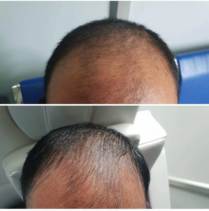 
Hair Loss Treatment Otesaly Mesotherapy Solution Serum for Hair Growth 