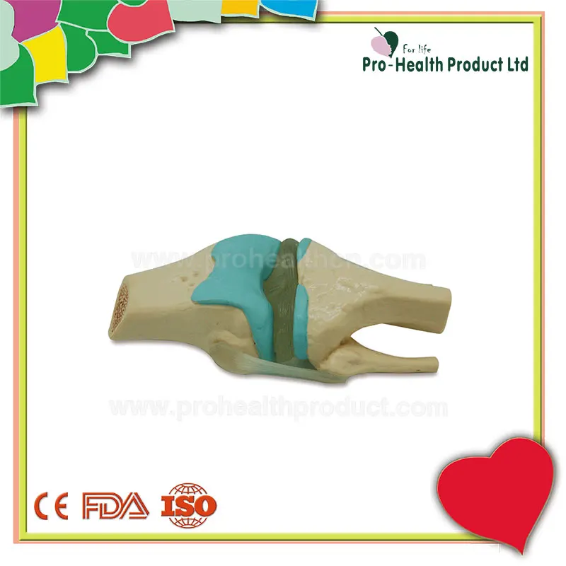 Joint Disease Knee Lesions Arthritis Knee Osteoarthritis Model Four Stage Degenerative
