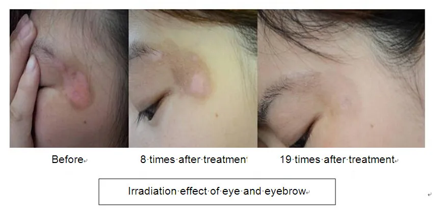 CE has approved 308nm excimer system for vitiligo psoriasis treating machine