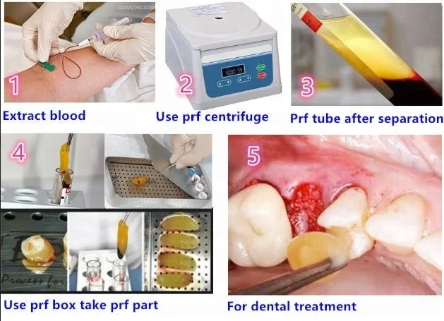 Portable clinical dental implant prf box prf tube prf treatment dental centrifuge