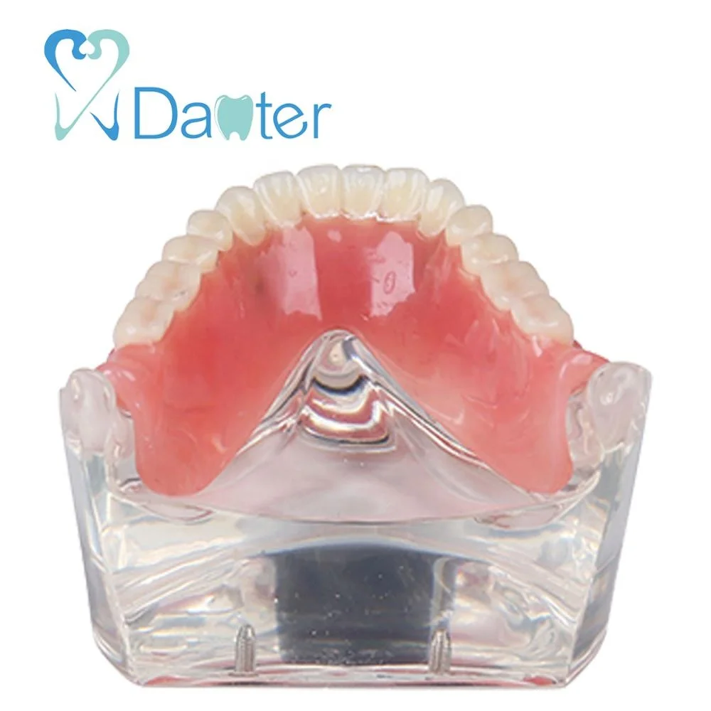 high quality overdenture model with 2 implants