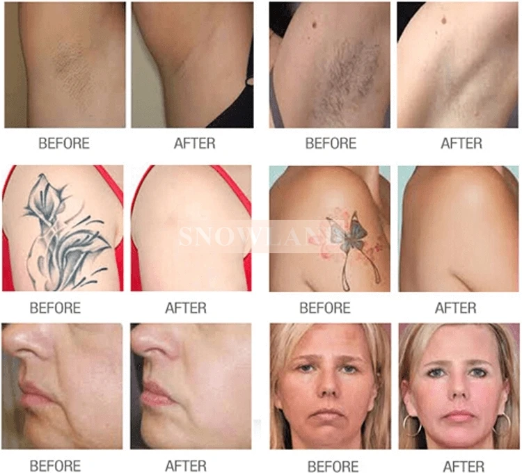  Профессиональная машина для лазерной эпиляции shr ipl продажи по оптовой цене