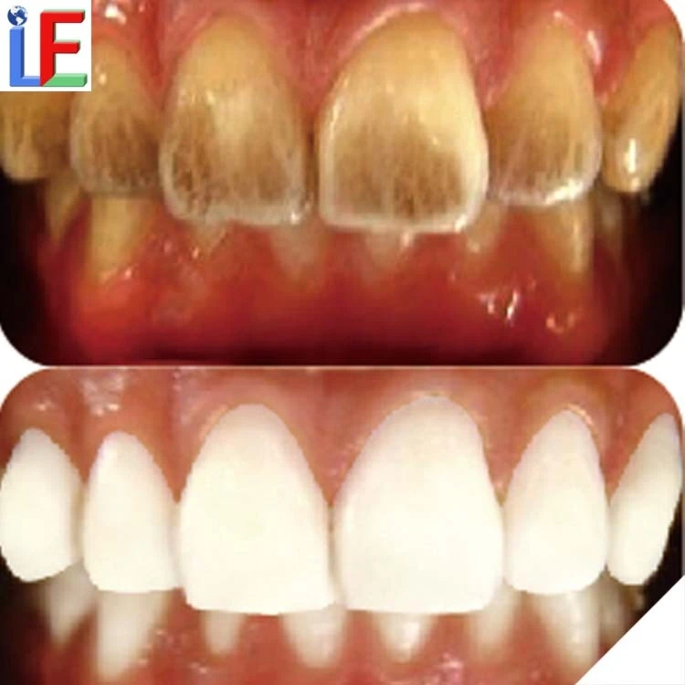 Home Use Teeth Whitening Bright White melamine Tooth Kit Unique China Special Tooth Whiter strips for Personal oral care