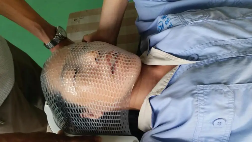 Иммобилизационное устройство термопластичная лучевая маска для онкологического пациента