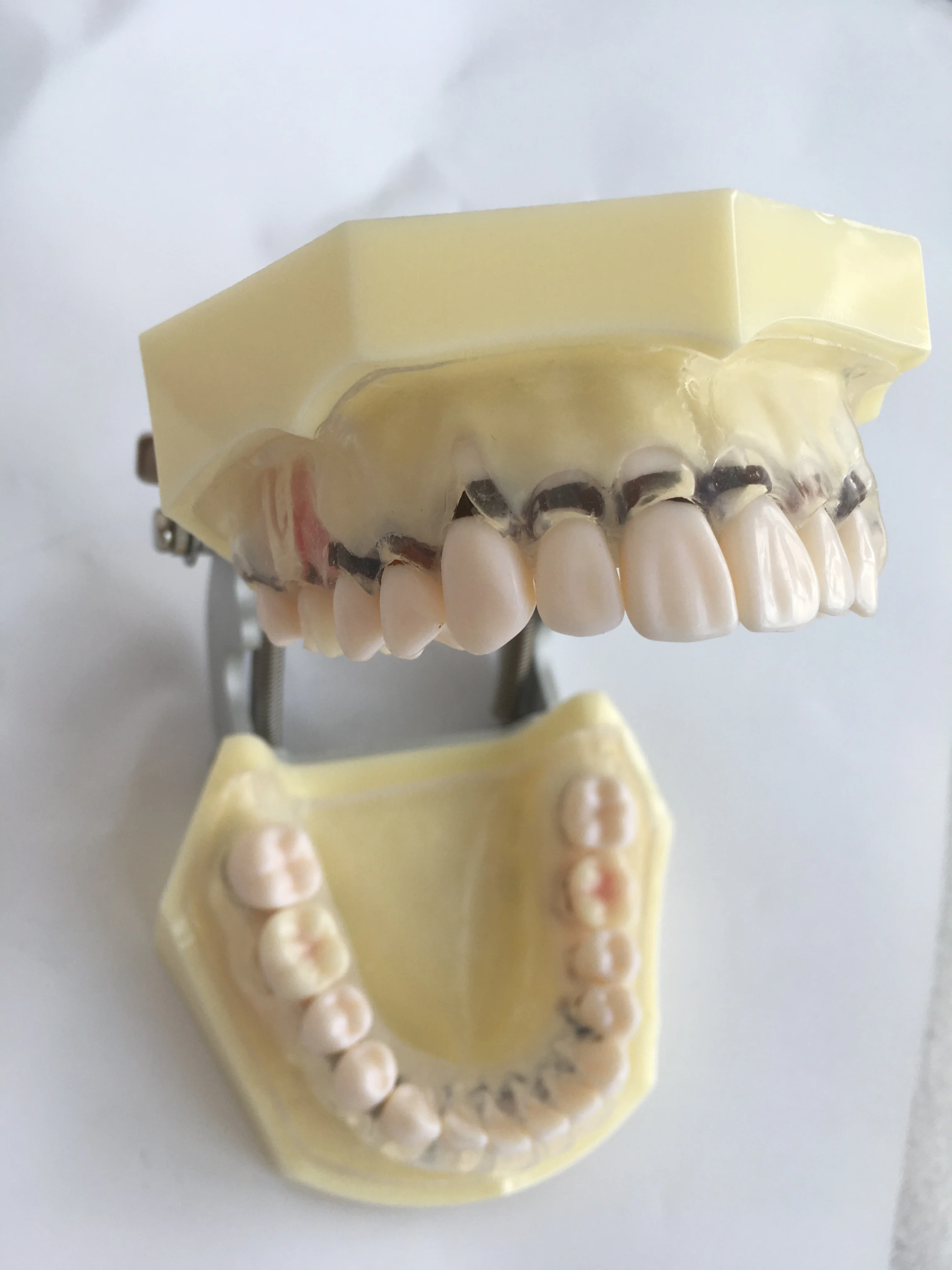 Peroidontal disease dental model with transparent clear gum demostrates ginivae recession