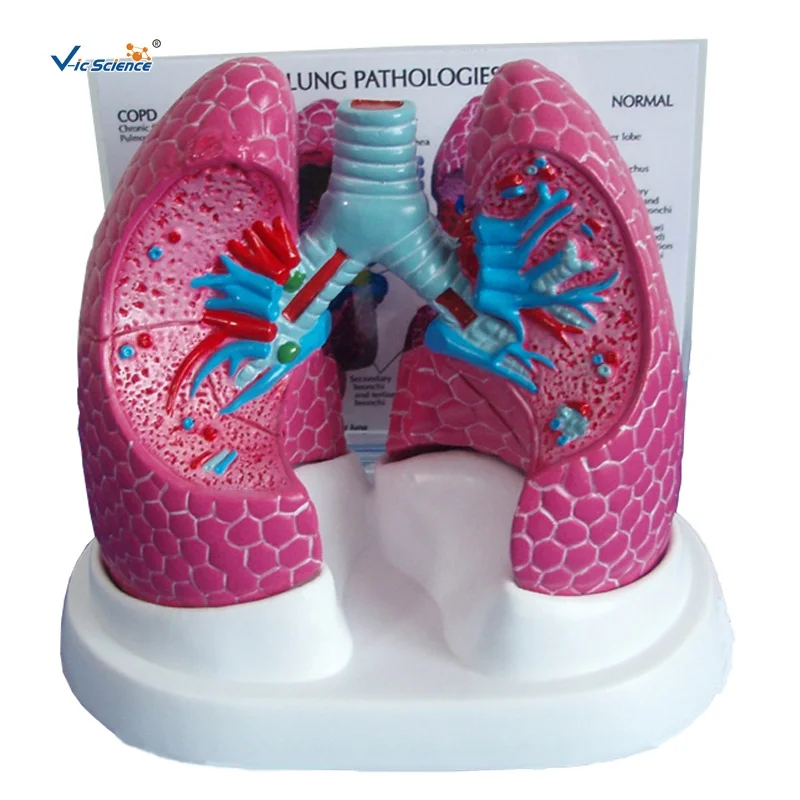 Plastic Medical Anatomical Teaching Bronchopulmonary Disease Pathological Lung Model for