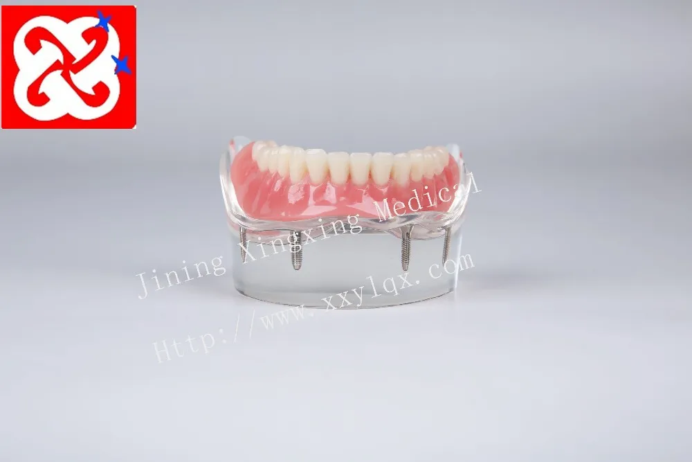Mandibular overdenture имплантат зубов с 4