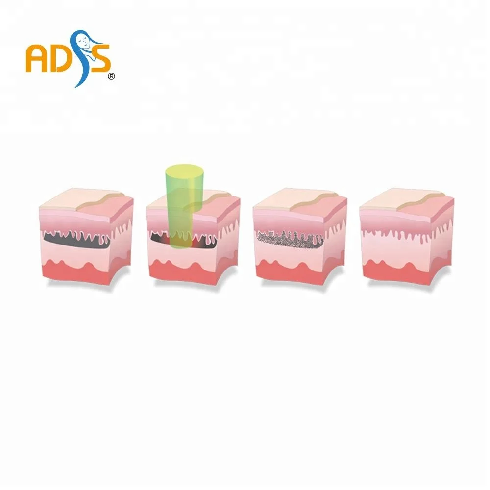 2024  cheapest  Laser tattoo removal ----RY 580  TATTOO REMOVAL SKIN REJUVENATION