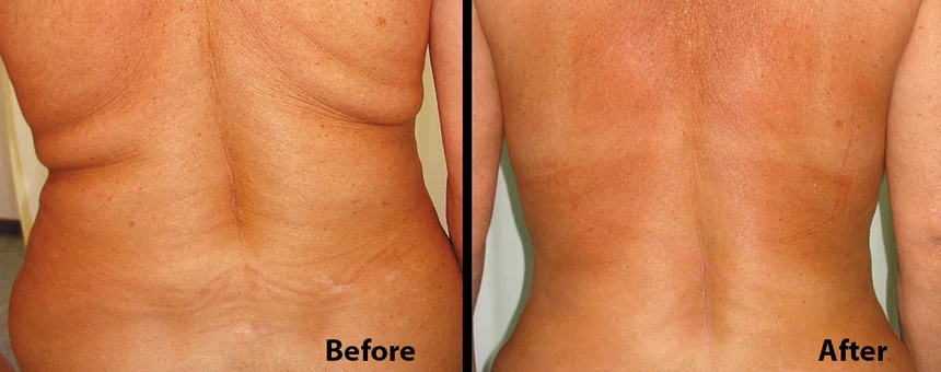 Lipo Laser Slimming Machine/Lipolysis Laser/lipolaser Fat Loss lipolaser portable pads slimming beauty machine