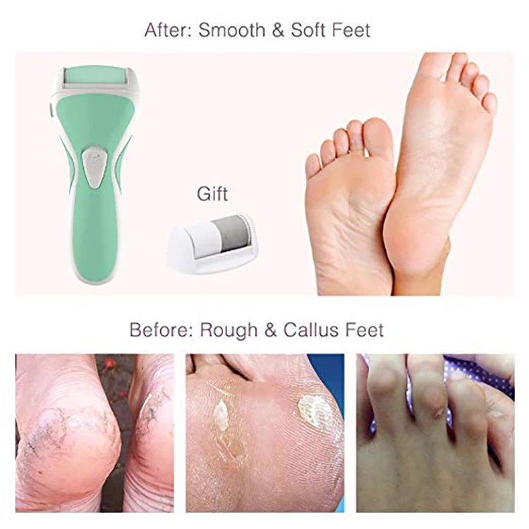 CHOICE Rechargeable Electric Callus Remover, Electric Usb Rechargeable Foot Callus Remover, Electric Callous Remover