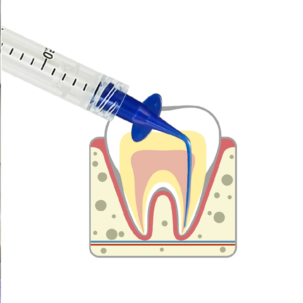  2ml disposable dental syringe with plastic luer-lock pre-bent needle