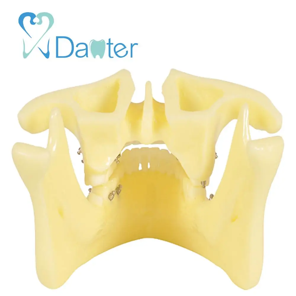 China Dental Implants Dental Orthodontic Model with Ortho Implant