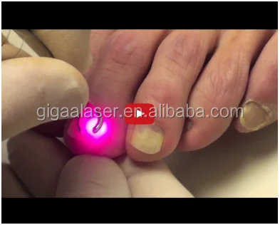 Gbox 980nm diode Laser for podiatry treatment laser machine