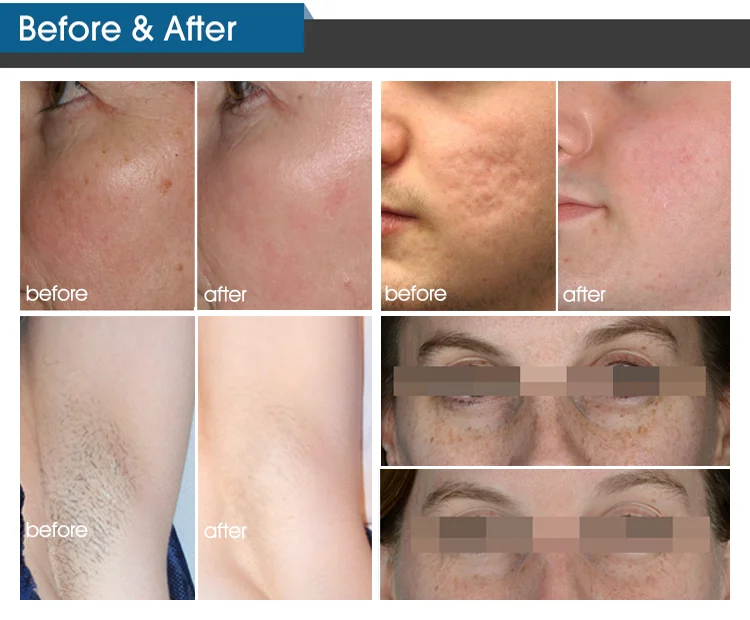 ADSS approved IPL hair removal SHR beauty machine VE2020