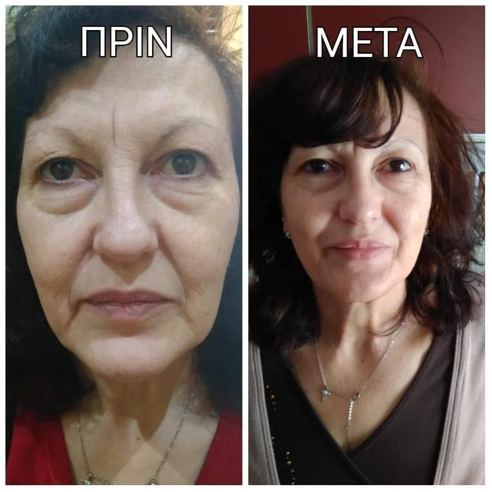 opt rf nd yag laser hair removal machine 4 in 1 multifunctional beauty esthetician equipment picosecond laser yag tattoo removal