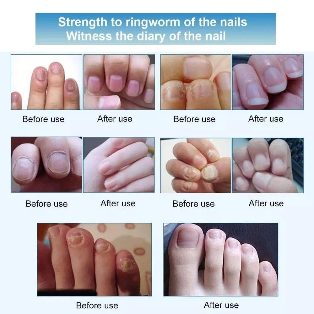 2pcs Nail Treatment Pen Infection Nail Repair Pen Fungal Treatment Anti Fungus Biological Repair 3ml Restores Healthy Nails